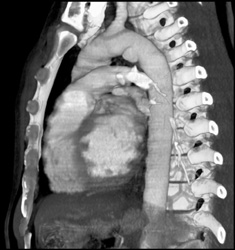 Traumatic Aneurysm in Arch - CTisus CT Scan