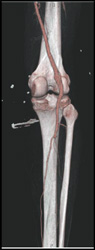 CTA- Patent Trifurcation Vessels - CTisus CT Scan