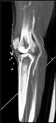 Popliteal Artery Aneurysm - CTisus CT Scan