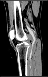 Popliteal Artery Aneurysm - CTisus CT Scan