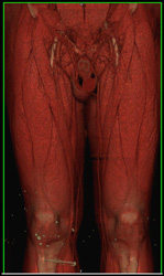 Normal Thigh Muscles - CTisus CT Scan