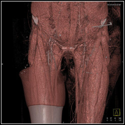 Small Inguinal Nodes - CTisus CT Scan