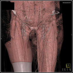 Narrowed Right Superficial Femoral Artery (SFA) in Patient With Below Knee Amputation (BKA) - CTisus CT Scan