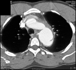 Aortic Dissection - CTisus CT Scan