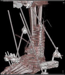 CTA Limited By Hardware - CTisus CT Scan