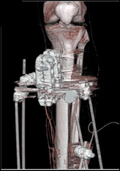 Patent Popliteal Artery - CTisus CT Scan