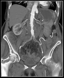 Occluded Graft From Aorta to Celiac Artery - CTisus CT Scan