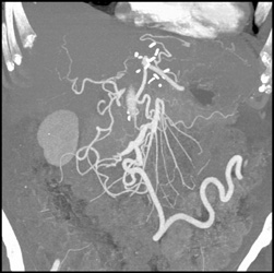 Collateral Vessels - CTisus CT Scan