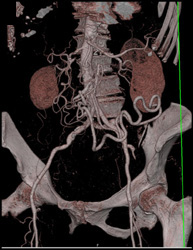 Collaterals Due to SMA Occlusion - CTisus CT Scan