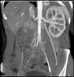 Prominent Gonadal Vein - CTisus CT Scan