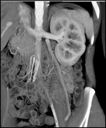 Normal Gonadal Vein - CTisus CT Scan