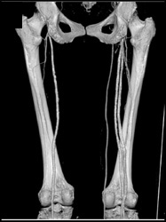 Early Venous Flow on Left - CTisus CT Scan