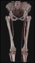 Early Venous  Flow on Right - CTisus CT Scan