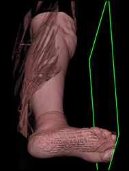 Nice 3D Foot - CTisus CT Scan