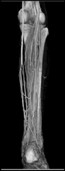 Normal CTA - CTisus CT Scan