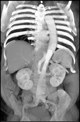 Abdominal Aortic Aneurysm (AAA) With Dissection - CTisus CT Scan