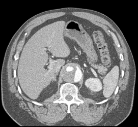 Aortic Dissection - CTisus CT Scan