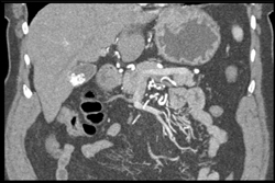 Collaterals Due to Stenosis - CTisus CT Scan