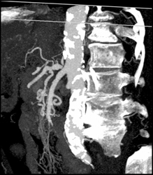 Celiac Artery Stenosis With Collaterals - CTisus CT Scan