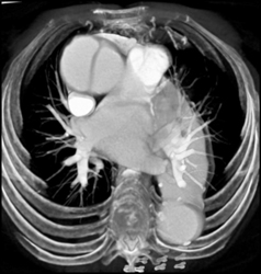 Ascending Aortic Dissection - CTisus CT Scan