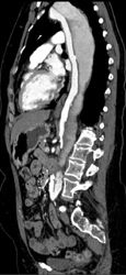 Aortic Dissection - CTisus CT Scan