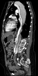 True and False Lumen - CTisus CT Scan