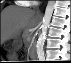 Calcified Plaque on Both Celiac And SMA - CTisus CT Scan