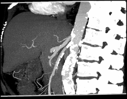 Calcified Plaque on SMA - CTisus CT Scan