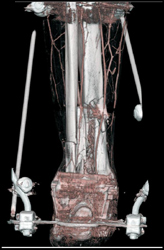 CTA for Pre-op Degloving Injury - CTisus CT Scan