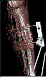 Good Vessel Definition Despite Metal Fixation Device - CTisus CT Scan