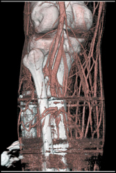 Drop Out of Vessel Segments Due to Metal Artifacts - CTisus CT Scan