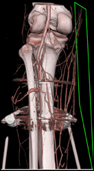 CTA With Artifact - CTisus CT Scan