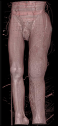 Klippel-Trenaunay-Weber (KTW) Syndrome Patient With Larger Left Leg Than Right - CTisus CT Scan