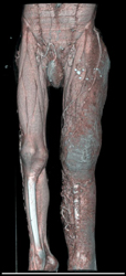 Multiple Venous Aneurysms and Lymphangiomas in Left Leg - CTisus CT Scan