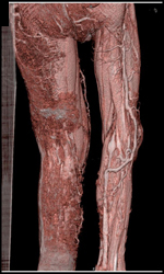 Klippel-Trenaunay-Weber (KTW) Syndrome- Venous Aneurysms in Left Leg - CTisus CT Scan