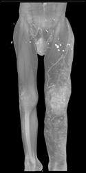 Klippel-Trenaunay-Weber (KTW) Syndrome With Lymphangiomas and Hemangiomas - CTisus CT Scan