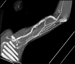 Av Shunt in Arm - CTisus CT Scan