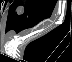 Av Shunt With Stenosis - CTisus CT Scan