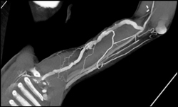 Av Graft With Stenosis - CTisus CT Scan