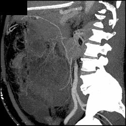 Clot in SMA - CTisus CT Scan