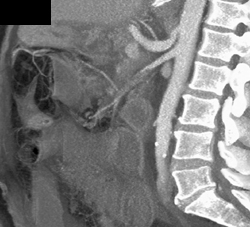 Intestinal Ischemia: Clot in SMA - CTisus CT Scan