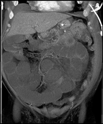 Infarcted Bowel With Pneumatosis - CTisus CT Scan