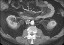 Renal Artery Aneurysm on Right - CTisus CT Scan