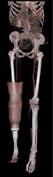 BK Amputation on the Right and Normal Leg Superficial Femoral Artery (SFA) - CTisus CT Scan