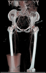 Patent Superficial Femoral Arteries (SFAs) - CTisus CT Scan