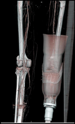 Patent Trifurcation on the Left - CTisus CT Scan