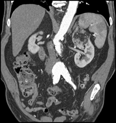 Abdominal Aortic Aneurysm (AAA) With Ulceration - CTisus CT Scan