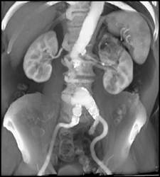 Abdominal Aortic Aneurysm (AAA) Plus Incidental Angiomyolipoma (AML) Left Kidney - CTisus CT Scan