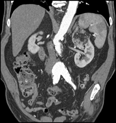 Angiomyolipoma (AML) With Abdominal Aortic Aneurysm (AAA) - CTisus CT Scan