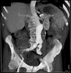 Abdominal Aortic Aneurysm (AAA) - CTisus CT Scan